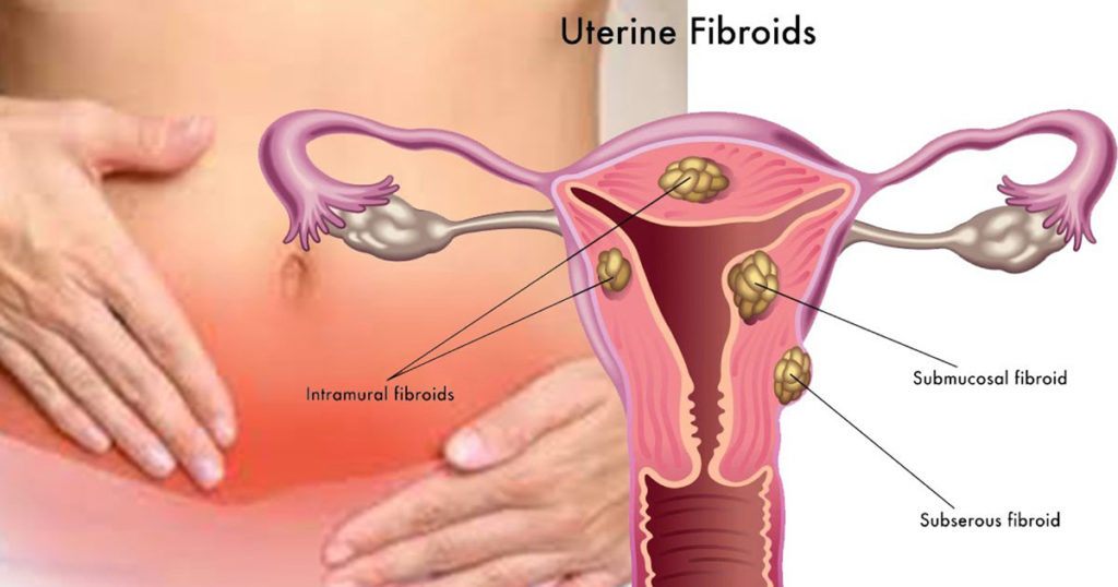 Fibroid Remedies 