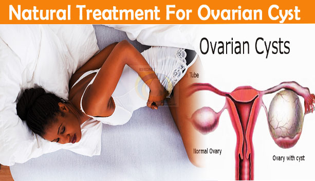 Natural Treatment For Ovarian Cyst