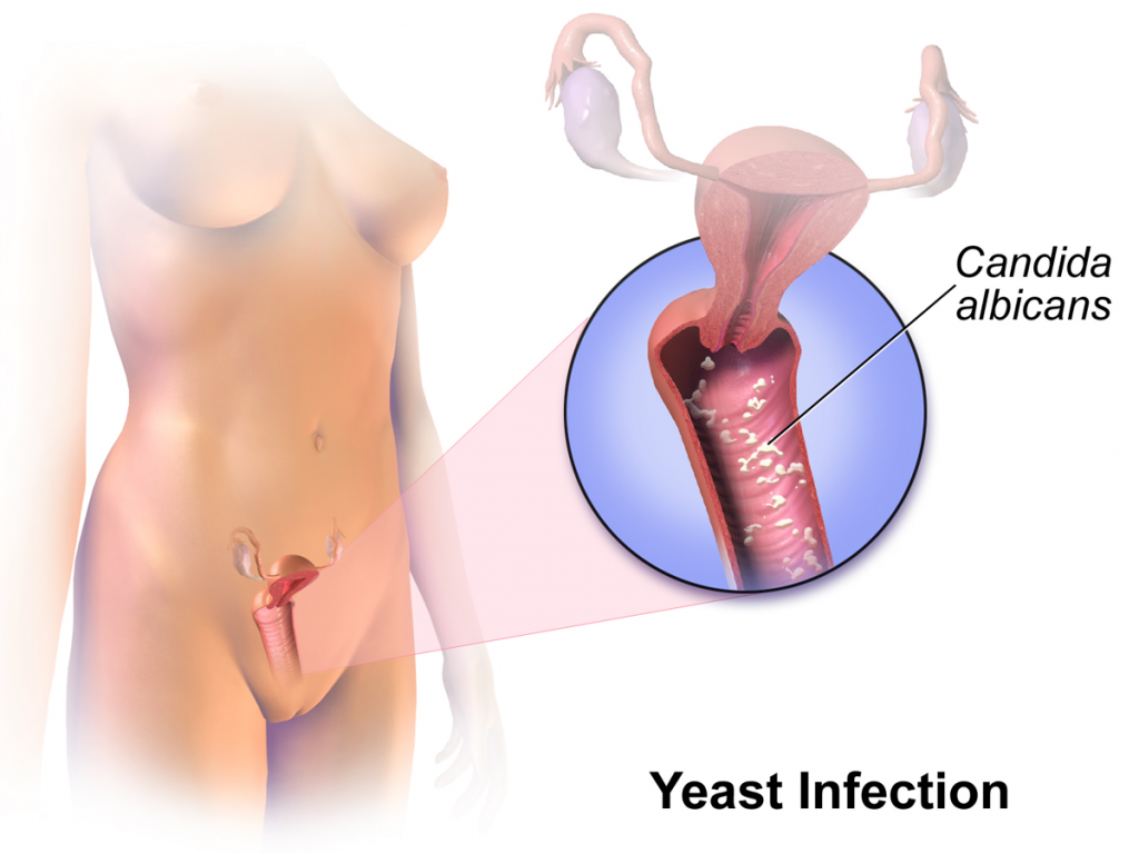 Vaginal yeast infection 