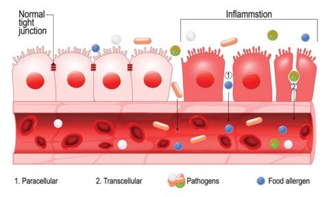 leaky gut